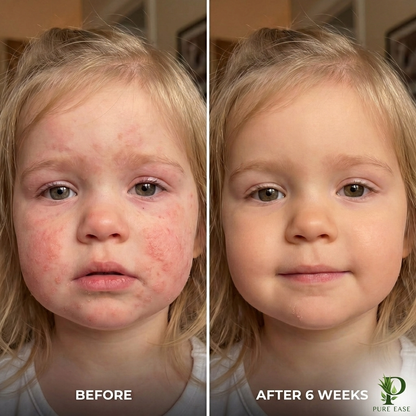 Pure Ease™ Relief Cream – Soothing Itch & Flare Relief